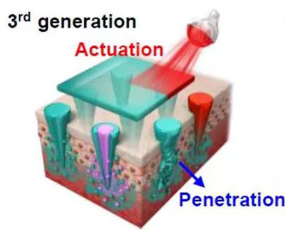 第三代：通过微针介导的皮肤层破坏和微针伴随的各种功能增强药物转运.jpg